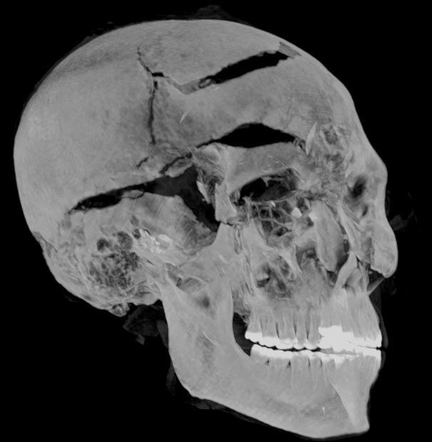 The mystery of the death of the Egyptian pharaoh was revealed with the help of CT