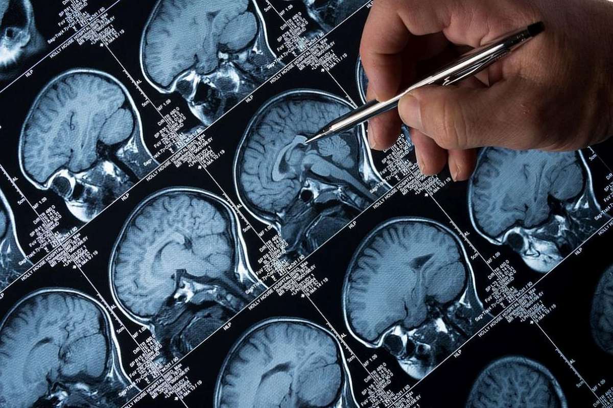 Революционное открытие о болезни Альцгеймера