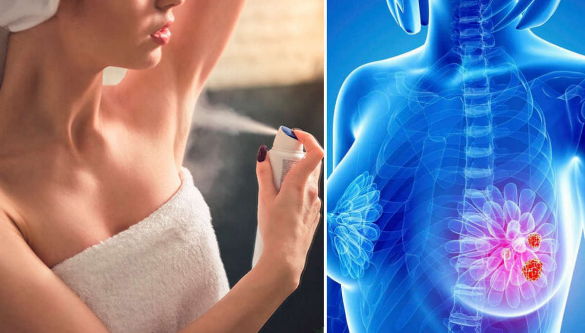 Лікар розповів, чи може дезодорант спричинити рак молочної залози