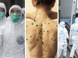 На популярних курортах почала поширюватися мавпяча віспа: виявлено заражених туристів