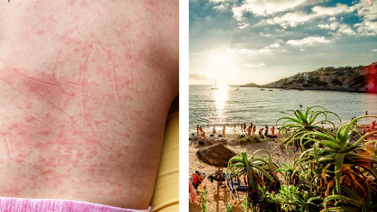 На популярному іспанському острові Ібіца, туристи масово заражаються лихоманкою денге